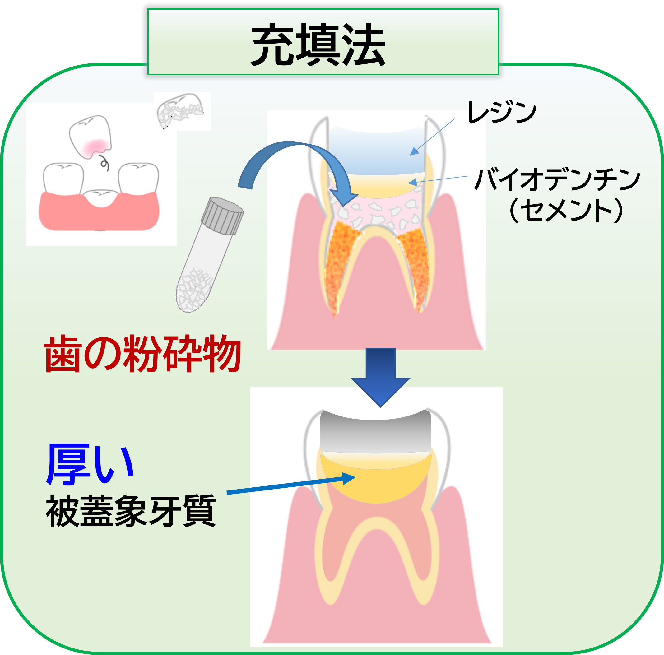 象牙質膜生成の治療プロセス
